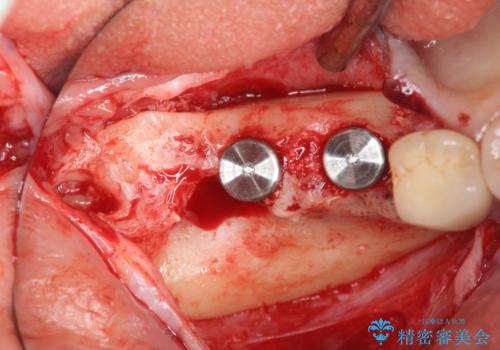 臼歯部インプラント治療の治療中