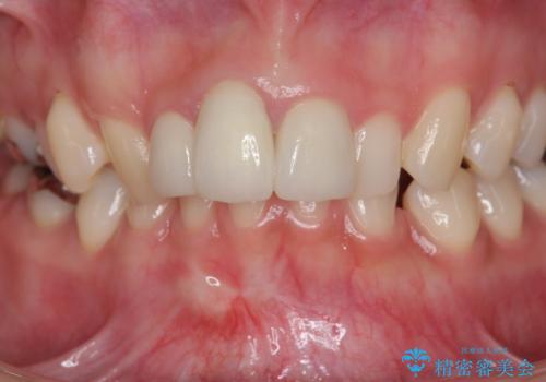 [ セラミック治療 ]前歯を審美的に治して欲しいの治療後