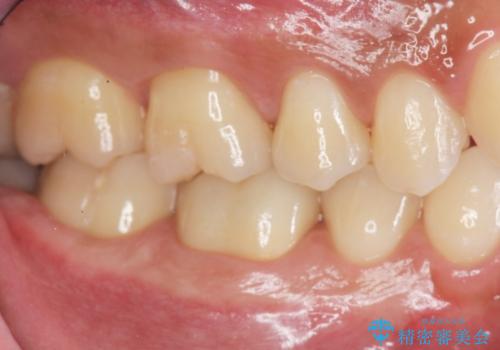 放置してしまった虫歯の治療の治療後