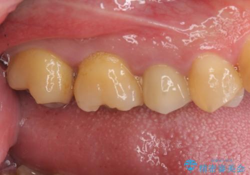 放置していた虫歯 セラミックインレーによる治療の治療前