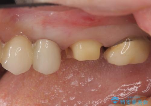 時々しみる奥歯 適合の悪いインレーからクラウンへのやり替えの治療中