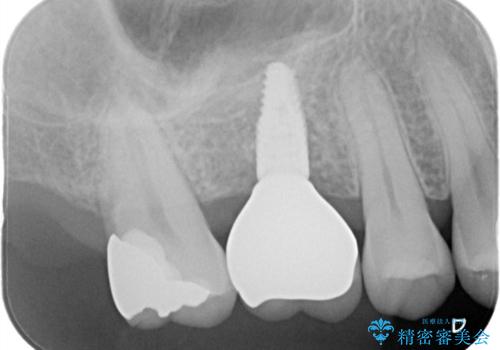 欠損している歯をインプラント治療により元のように咬めるようにの治療後