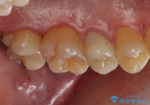 放置していた虫歯 セラミックインレーによる治療の治療後