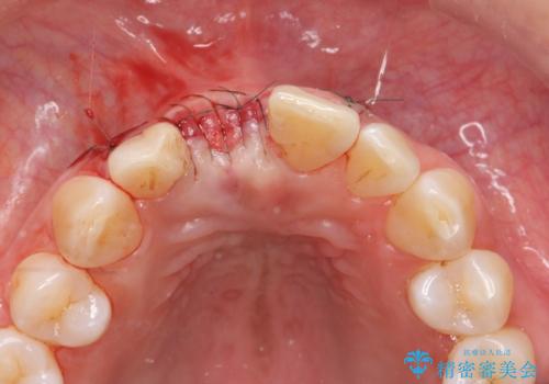 骨造成を伴う前歯のインプラント治療の治療中