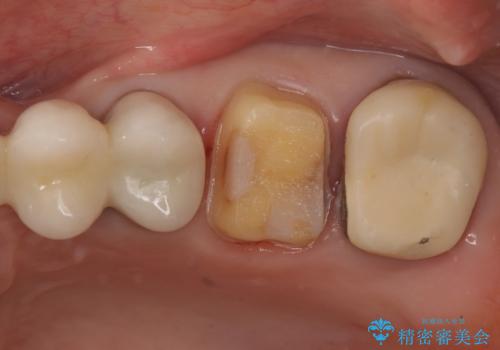 時々しみる奥歯 適合の悪いインレーからクラウンへのやり替えの治療中
