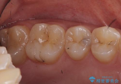 症状のない虫歯　セラミックインレーでの治療の症例 治療前