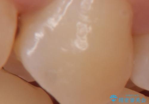 奥歯の虫歯　セラミックインレーによる治療の治療前