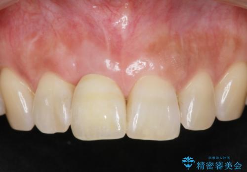 骨造成を伴う前歯のインプラント治療の治療後