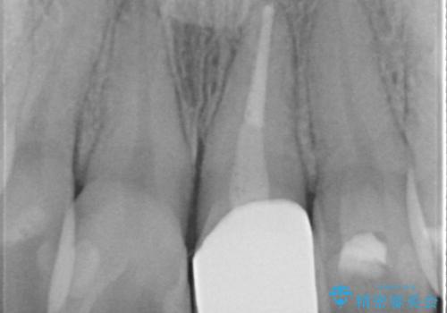 矯正治療が終了し、前歯を治したいの治療後