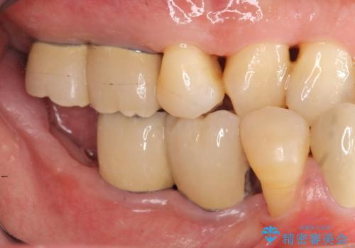 インプラント治療を併用した全顎歯周病治療の治療後