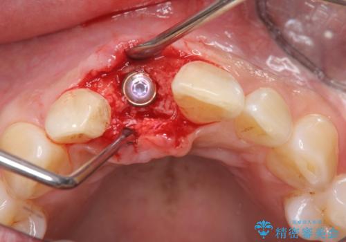 骨造成を伴う前歯のインプラント治療の治療中