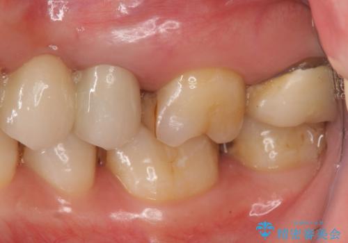 時々しみる奥歯 適合の悪いインレーからクラウンへのやり替えの治療前