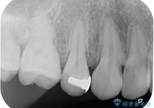 矯正終了し、銀歯が見えるため治してほしい。セラミック治療の治療前