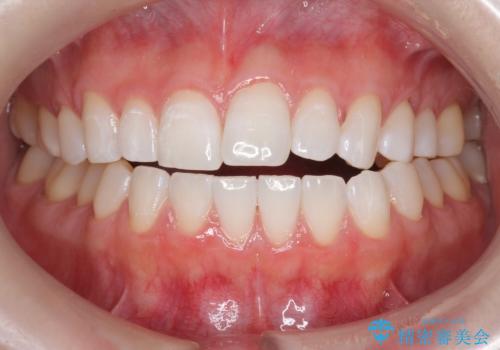 オフィスホワイトニング(エクセレントコース)の治療後