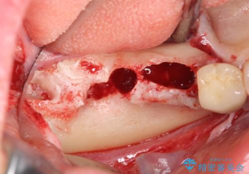 臼歯部インプラント治療の治療中
