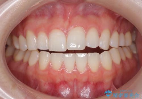 オフィスホワイトニング(エクセレントコース)の治療前