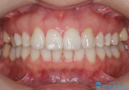 初めてのオフィスホワイトニングの治療前