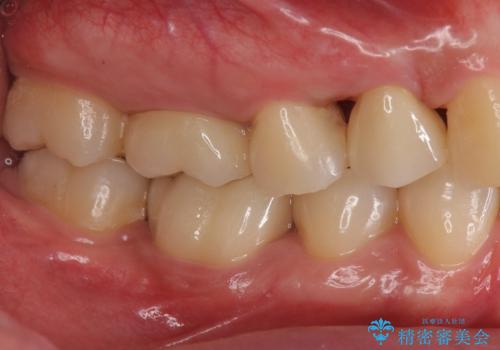 銀歯のやり替え　セラミックで白い歯にの治療後
