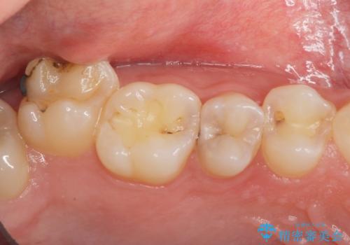 検査で見つかった虫歯　セラミックインレーでの治療の治療前