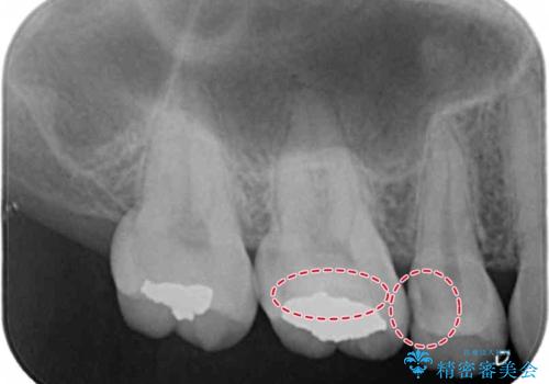 たまにしみる奥歯 セラミックインレーでの修復の治療前