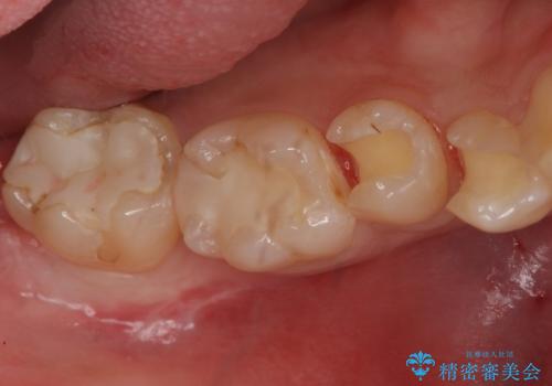 検査で見つかった虫歯 セラミックインレーでの修復の治療中