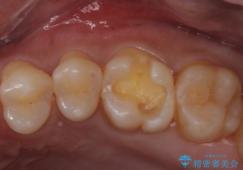 奥歯に隠れた虫歯 セラミックインレーでの修復の治療中
