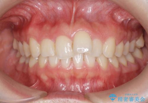 前歯のガタつきをきれいに　マウスピース矯正治療の症例 治療前