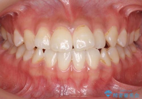 口元の印象が変わります。　引っ込んでいる前歯を出す治療の症例 治療前