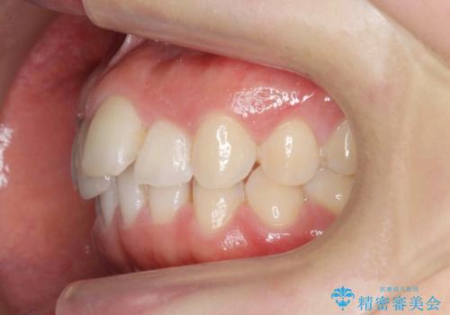 前歯のガタつきをきれいに　マウスピース矯正治療の治療前