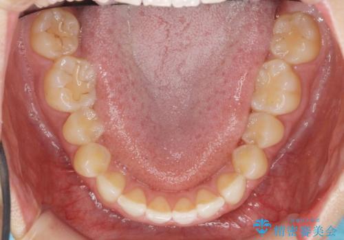 前歯のガタつきをきれいに マウスピース矯正治療の治療前