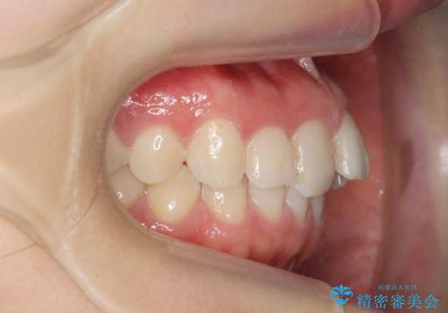 前歯のガタつきをきれいに　マウスピース矯正治療の治療前