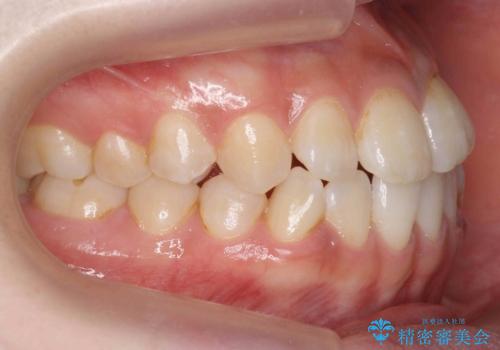 口元の印象が変わります。　引っ込んでいる前歯を出す治療の治療前