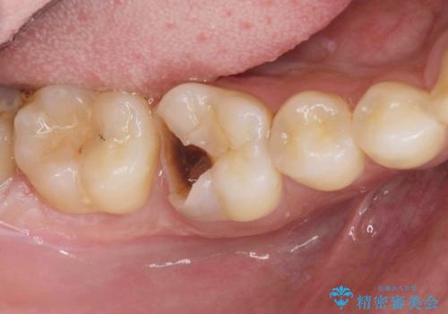 放置してしまった虫歯の治療の治療前