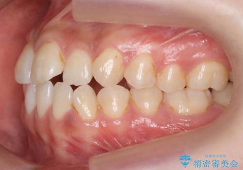 口元の印象が変わります。　引っ込んでいる前歯を出す治療の治療前