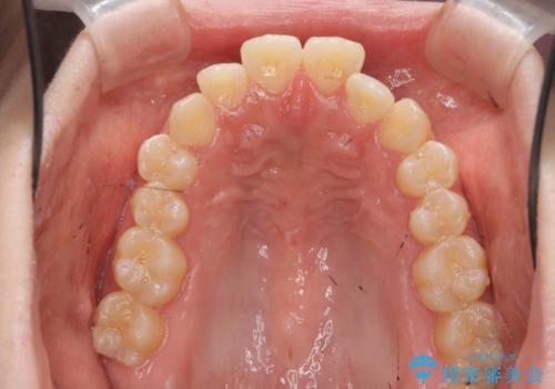 口元の印象が変わります。 引っ込んでいる前歯を出す治療の治療前