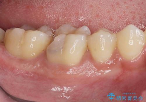 放置してしまった虫歯の治療の治療前