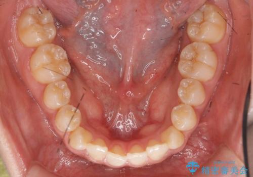 口元の印象が変わります。 引っ込んでいる前歯を出す治療の治療前