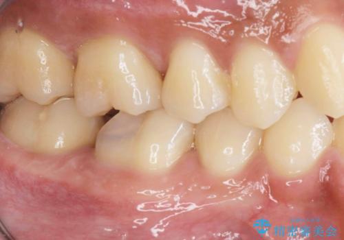 放置してしまった虫歯の治療の治療前
