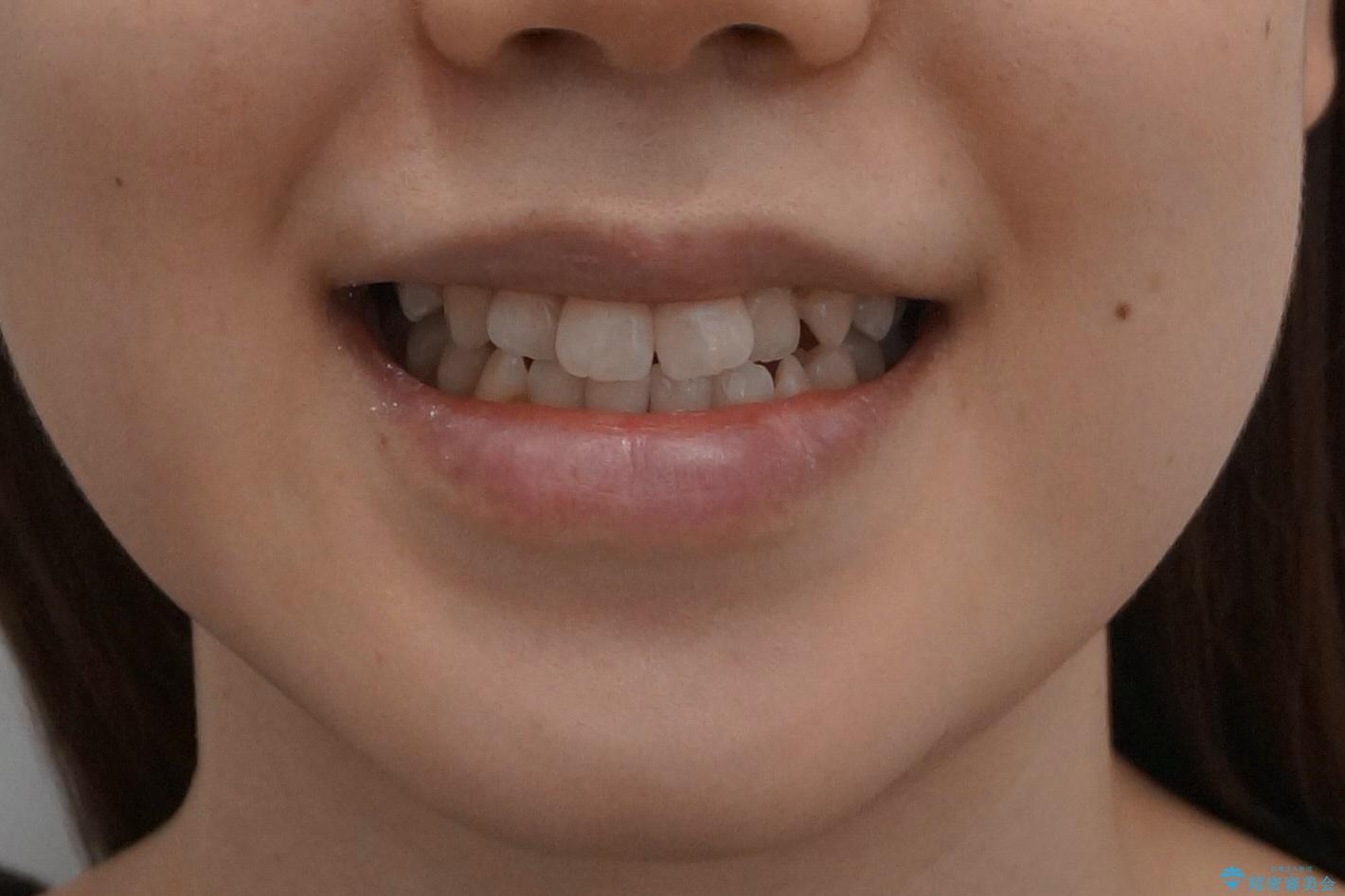 口元の印象が変わります。　引っ込んでいる前歯を出す治療の治療前（顔貌）