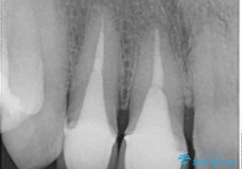 前歯のすき間 以前よりも広がってきた 二度と広がらないようにしたい セラミック治療の治療前