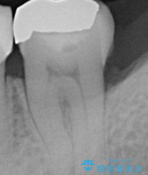 銀を白くしたいの治療前