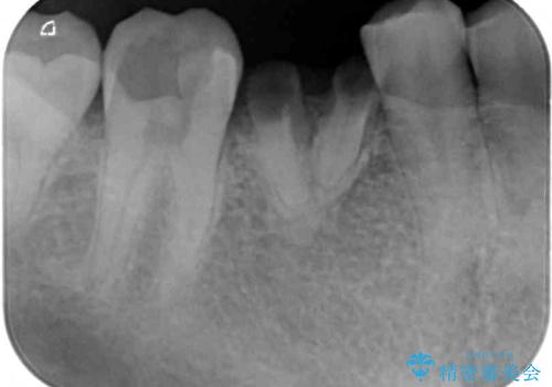 放置した虫歯 奥歯のオールセラミックブリッジ治療の治療前