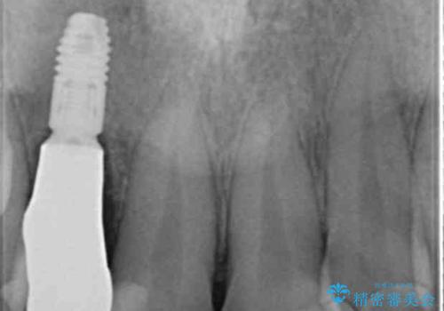 前歯の虫歯 オールセラミック治療の治療前