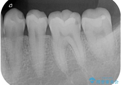 治療途中で放置した奥歯 セラミックインレーでの修復の治療前