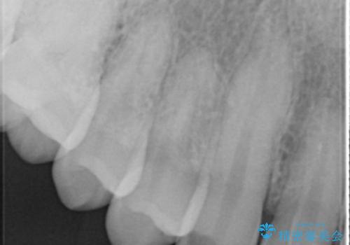 穴が開いた前歯 白いクラウンで修復の治療後