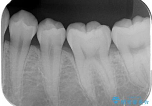 歯が黒いのが気になるの治療前