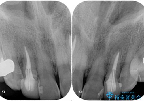 金属の見えてしまったクラウン セラミッククラウンで自然にの治療前