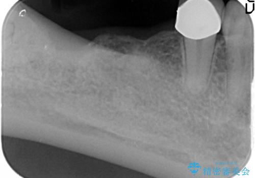 臼歯部インプラント治療の治療前