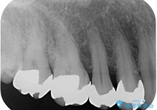 銀歯を白くしたい セラミックによる審美歯科治療の治療前