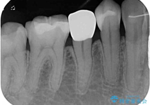 以前治療した詰め物が欠けた オールセラミッククラウンによる補綴の治療後